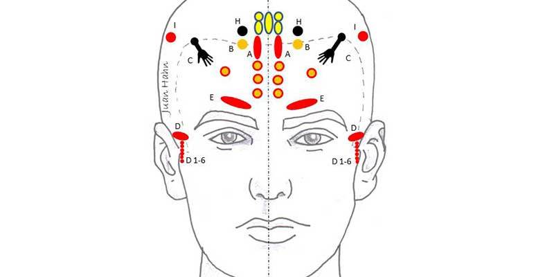 Aiguilles d'acupuncture filiformes